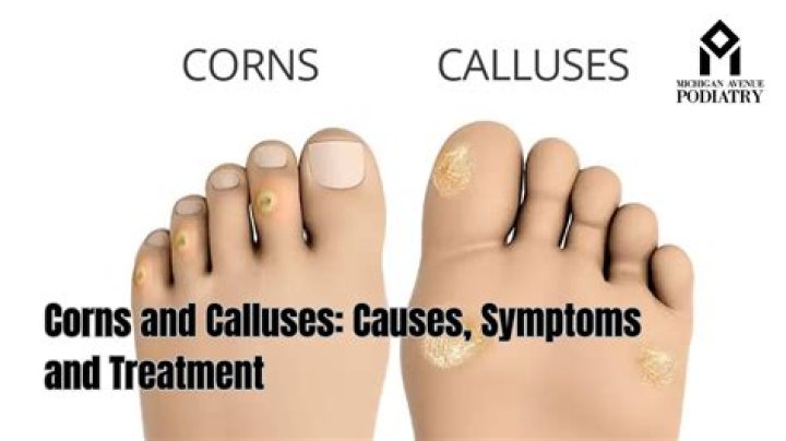 Are corns caused by tight shoes?
