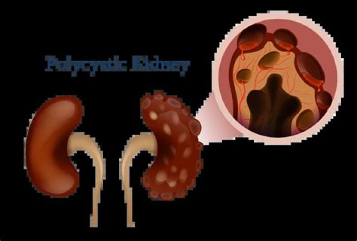 Are cysts on kidneys life threatening?