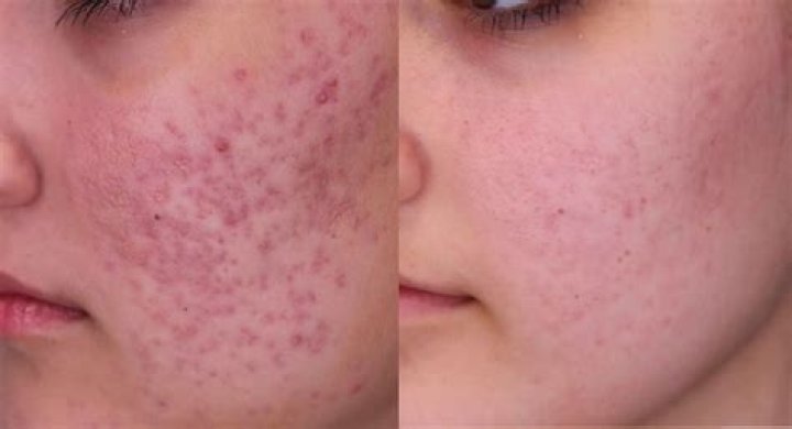 Are red marks from acne permanent?