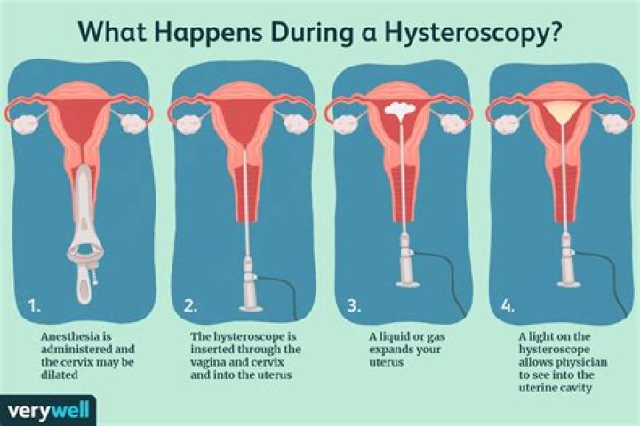 Are you awake for a hysteroscopy