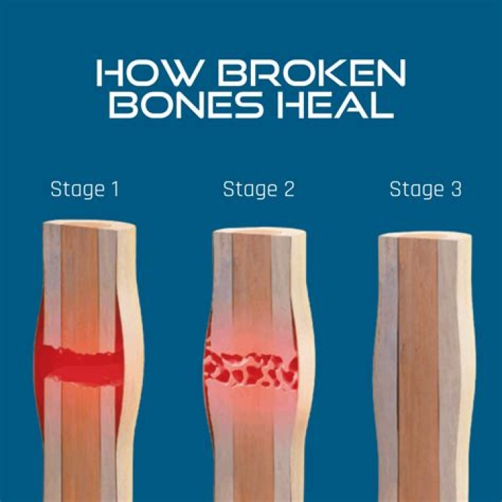 Can a broken bone cause gout?