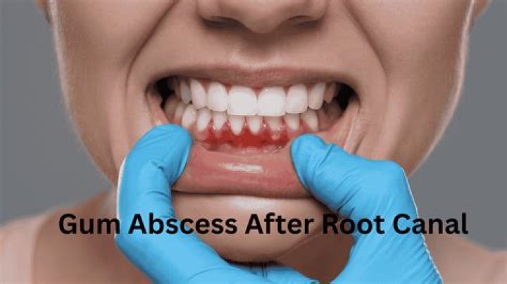 Can a gum abscess leave scar tissue?