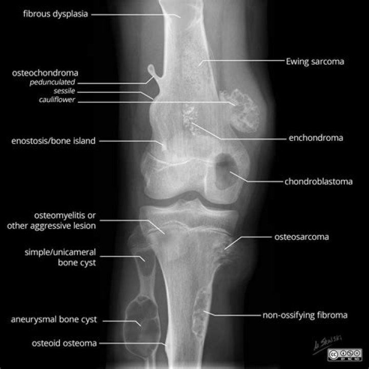 Can an osteochondroma become cancerous
