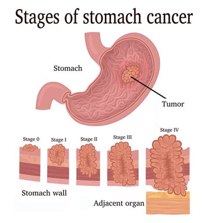 Can breast cancer spread to pancreas?