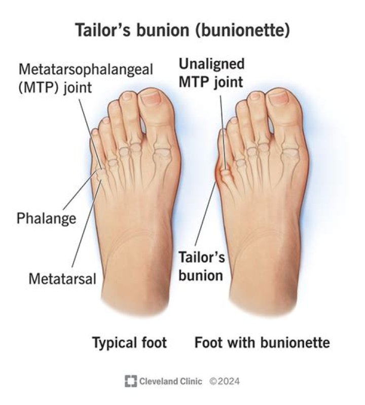 Can bunions cause pain in other toes?