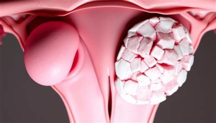 Can cancer be mistaken for fibroids?