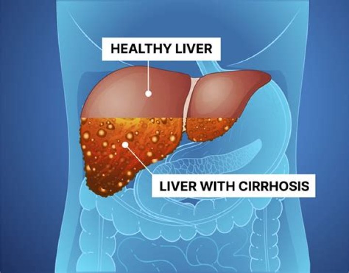 Can cirrhosis of the liver be a cause of upper digestive bleeding