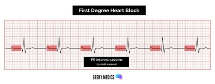 Can first degree heart block go away?
