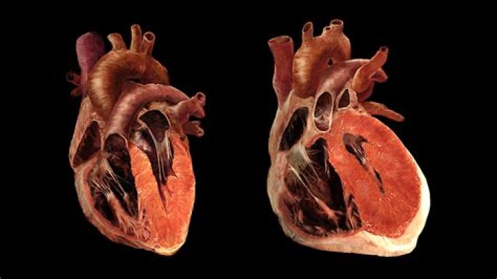 Can humans have an enlarged heart?