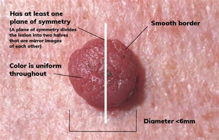 Can intradermal nevus become cancerous?