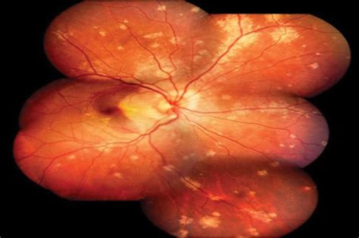 Can ocular sarcoidosis go away?