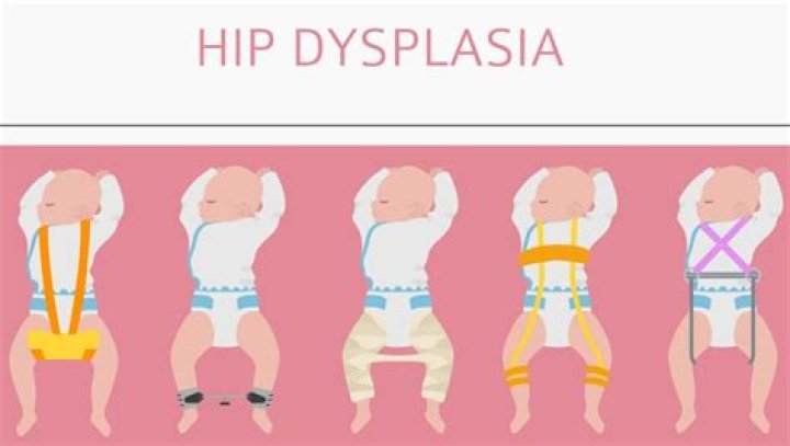 Can the Infantino carrier cause hip dysplasia?