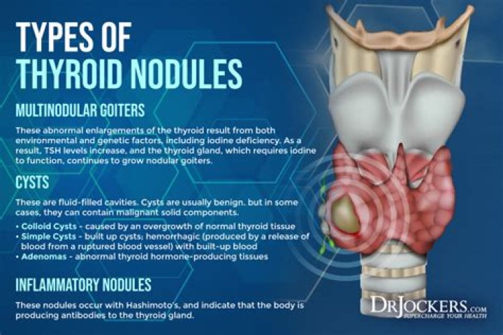 Can thyroid nodule affect your throat?