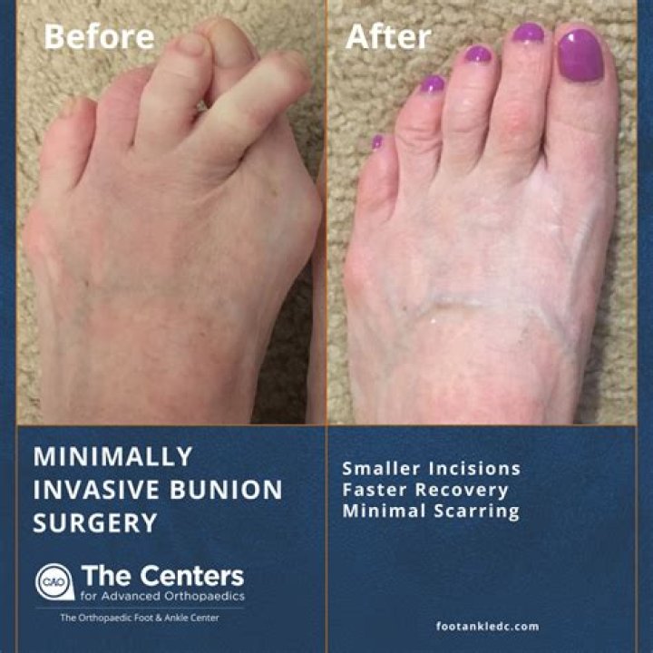 Can you have surgery on a mild bunion?