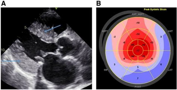 Can you see amyloidosis on a echocardiogram?