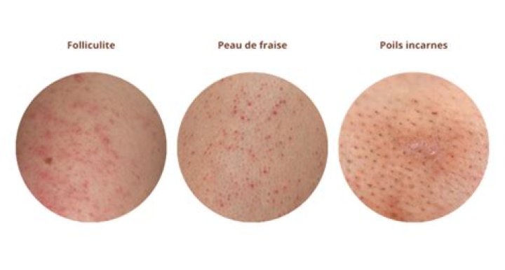 Comment soulager folliculite?