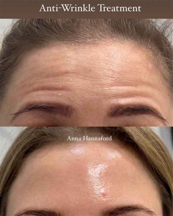 Do anti wrinkle face patches work?