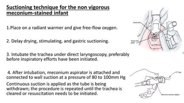 Do you suction a meconium baby