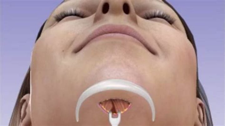 Does a chin implant feel weird?