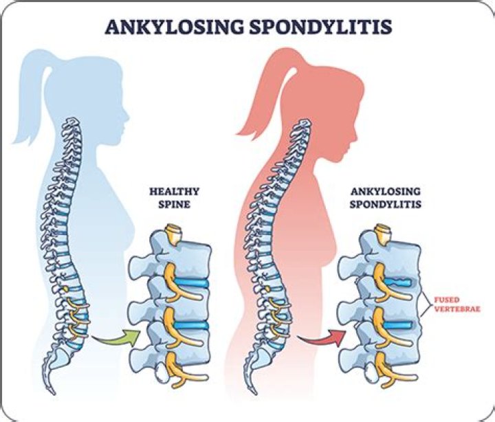 Does ankylosing spondylitis cause a weak immune system?