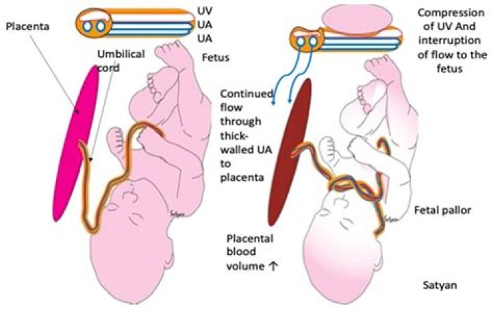 Does cord compression affect the fetus?