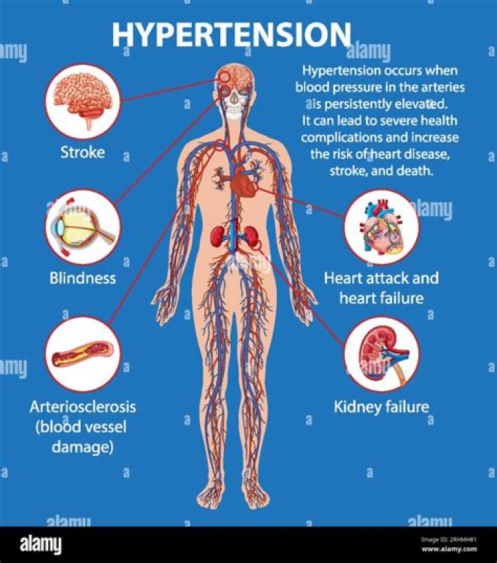 Does epistaxis cause hypertension?