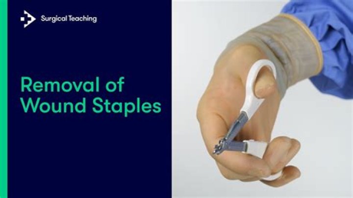 How are medical staples removed?