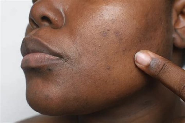 How do I get rid of dark skin on my face?
