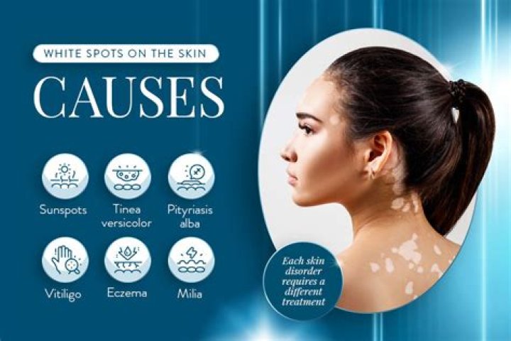 How do I get rid of white spots on my neck naturally?