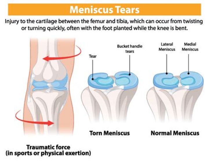 How do you check for a torn medial meniscus?