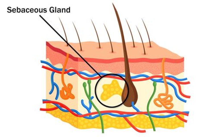 How do you get rid of a blocked sebaceous gland?