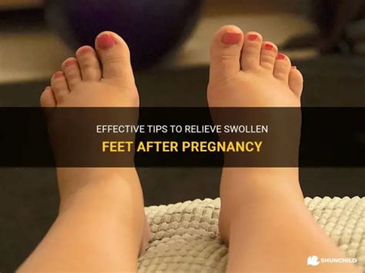 How do you get rid of swollen feet after pregnancy?