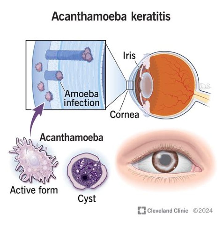 How do you treat Acanthamoeba in your eyes?