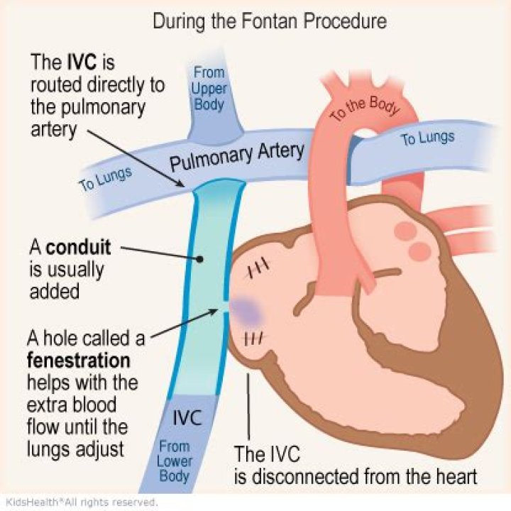 How does the Fontan procedure work?
