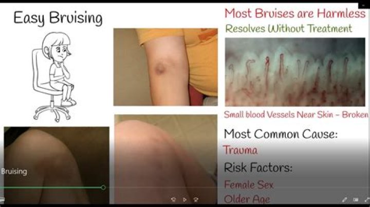 How easy do you bruise with leukemia?