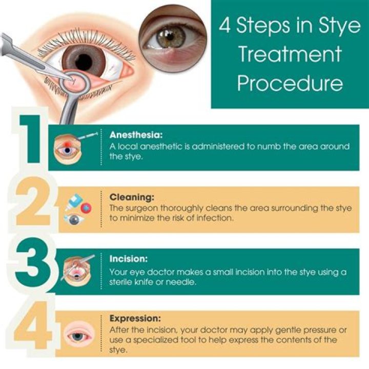 How is a stye removed surgically?