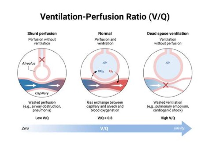 How is a ventilation perfusion scan performed?