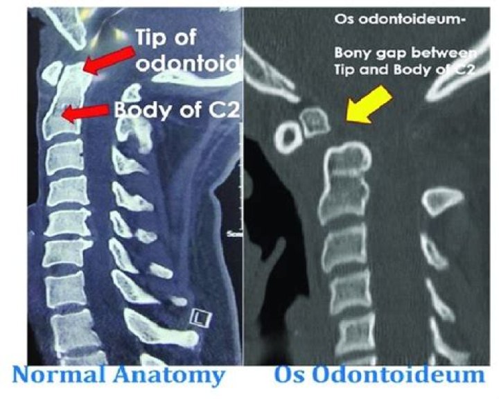 How is os Odontoideum treated?