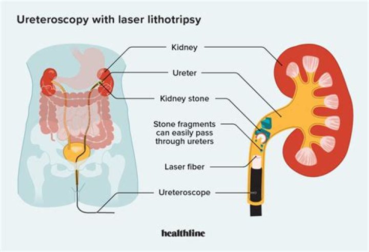 How lithotripsy is done