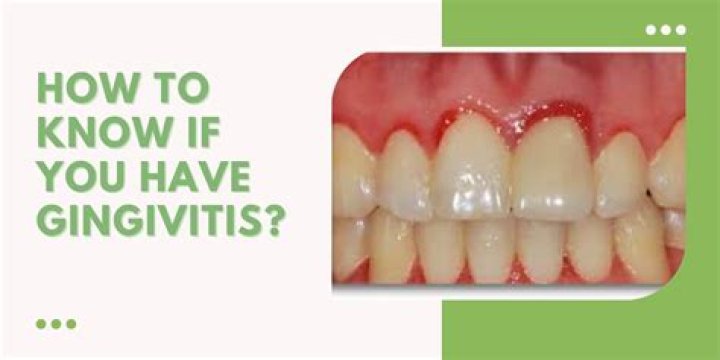 How long can you live with gingivitis