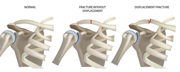How long does a displaced collarbone fracture take to heal?