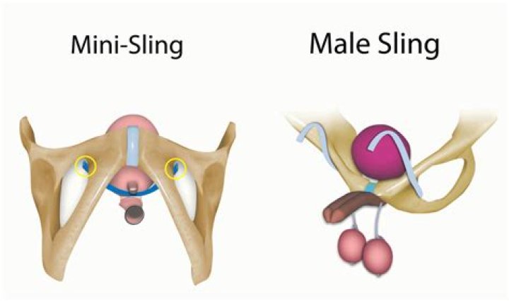 How long does a male sling last?