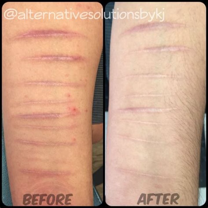 How long does it take for red scars to turn white?