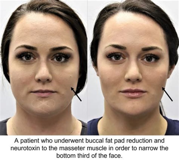 How long does it take to see results from buccal fat removal?