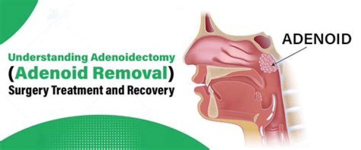How long is recovery from adenoidectomy?