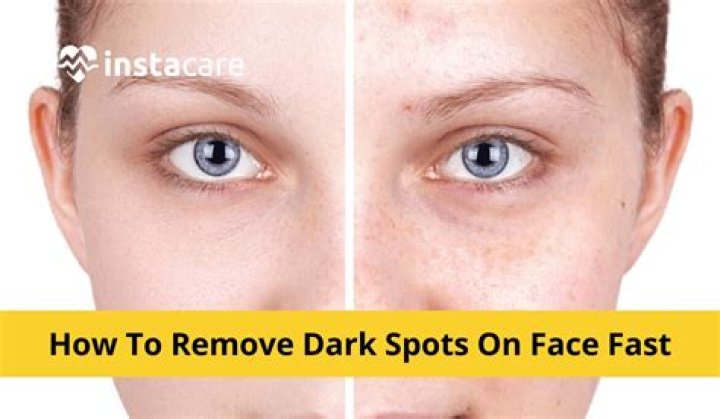 How remove dark circles at home fast?