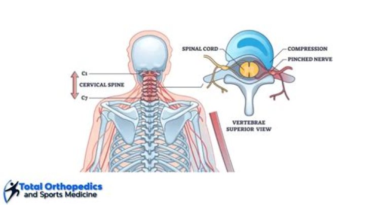 How serious is a spinal stroke?