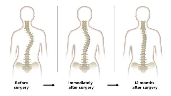 How successful is scoliosis surgery in adults?