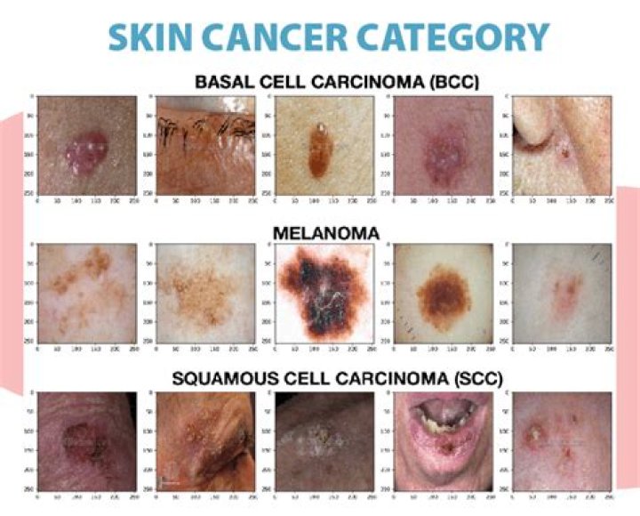 Is a skin cancer bump hard?