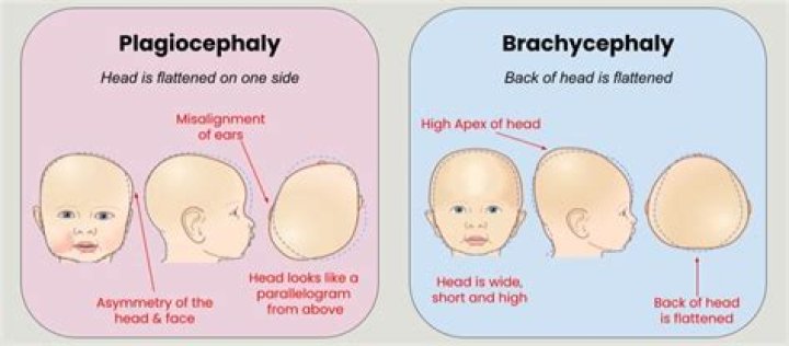 Is brachycephaly the same as plagiocephaly?